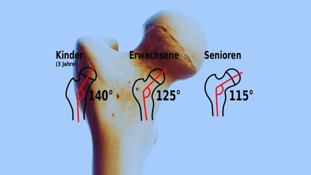 CCD-Winkel: Damit die Muskeln effektiver das Bein bewegen 2